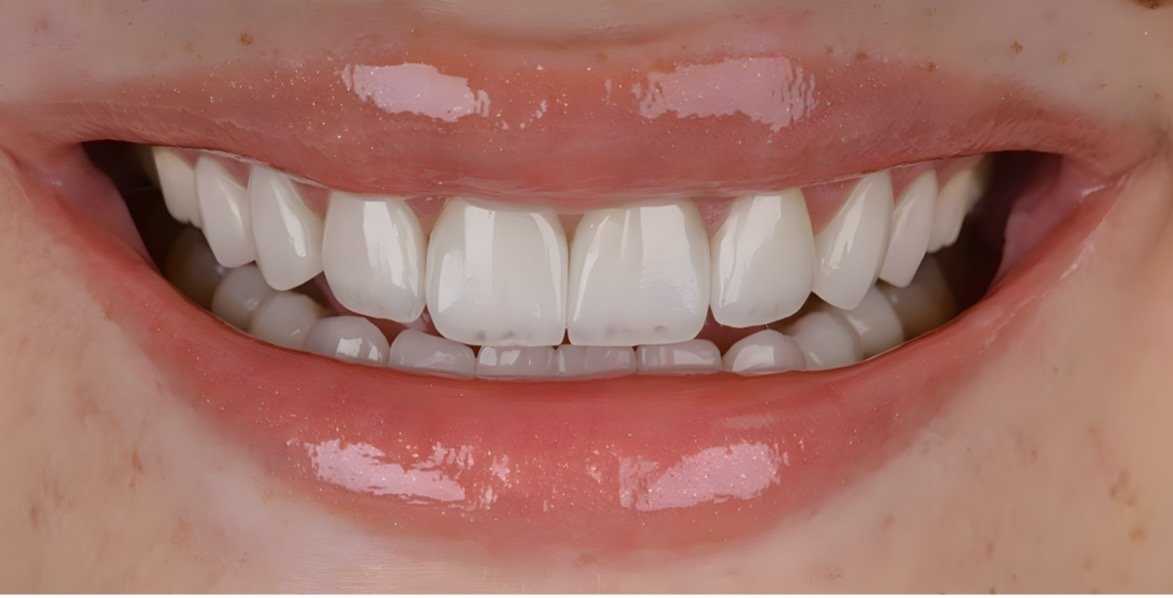 Voxel3Di Digital Smile Design 3D render